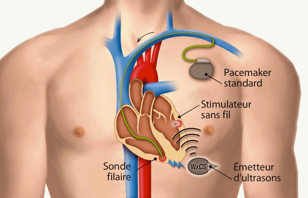types pacemakers